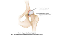 Dysplastic hip joint Image